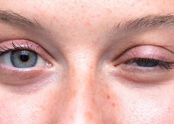 Ο κορωνοϊός μπορεί να προκαλέσει και νευρομυϊκή νόσο