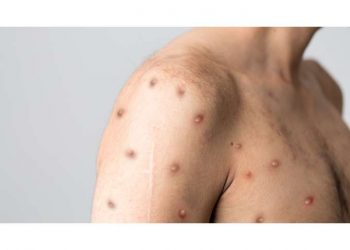 Φάουτσι για ευλογιά των πιθήκων: Υποεκτιμημένα τα κρούσματα – Πρέπει να τη λάβουμε σοβαρά υπ’όψιν